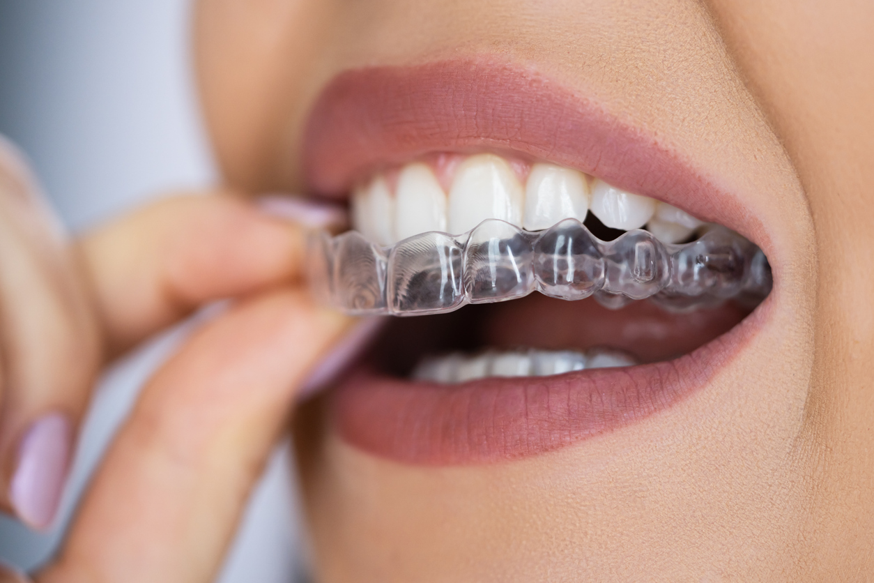 Why You Should Go to an Invisalign Dentist over an Orthodontist 5