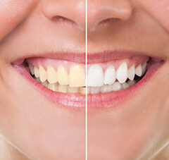 teeth whitening calgary