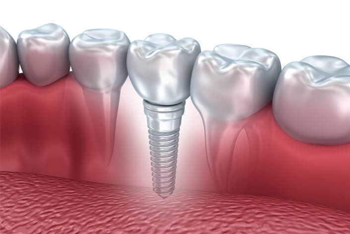 dental implants calgary