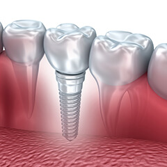 dental implants calgary