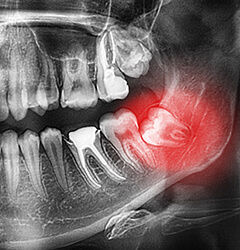 wisdom teeth extraction calgary